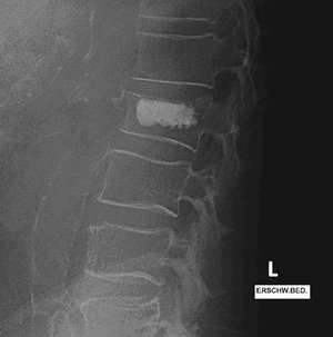 Röntgenbild der Lendenwirbelsäule mit Wirbelkörperfraktur und Kyphoplastie.