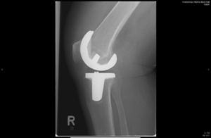 Röntgenbild eines Kniegelenkersatzes, sichtbar im rechten Kniebereich.