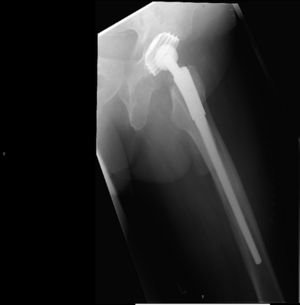Röntgenbild einer Hüftendoprothese, sichtbar links im Hüftbereich.