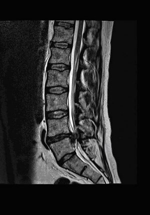MRT-Aufnahme der Lendenwirbelsäule, zeigt Bandscheiben und Wirbelkörper.