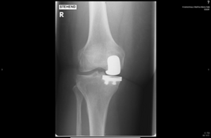 Röntgenbild eines Kniegelenkersatzes, sichtbar im rechten Kniebereich.