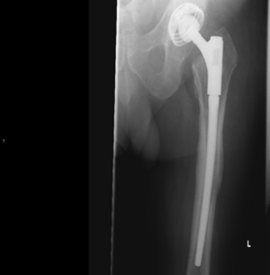 Röntgenbild einer Hüftendoprothese im linken Hüftbereich, deutlich sichtbar.