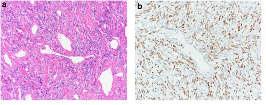Histologische Aufnahmen von solitären fibrösen Pleuratumoren in der Thoraxchirurgie.