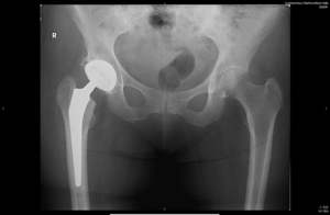 Röntgenaufnahme einer Hüftendoprothese im rechten Hüftbereich, deutlich sichtbar.