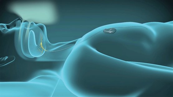 Schematische Darstellung eines Zungenschrittmachers zur Schlafapnoe-Therapie
