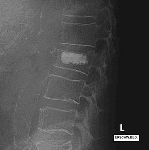Röntgenbild der Lendenwirbelsäule mit Wirbelkörperfraktur und Kyphoplastie.