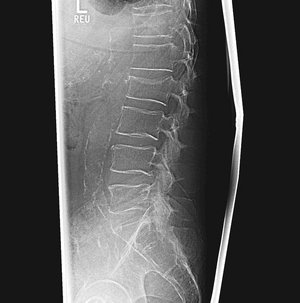 Röntgenbild der Lendenwirbelsäule zeigt Wirbelkörper und Bandscheiben deutlich.