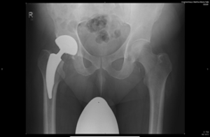 Röntgenaufnahme einer Hüftendoprothese, deutlich sichtbar im rechten Hüftbereich.