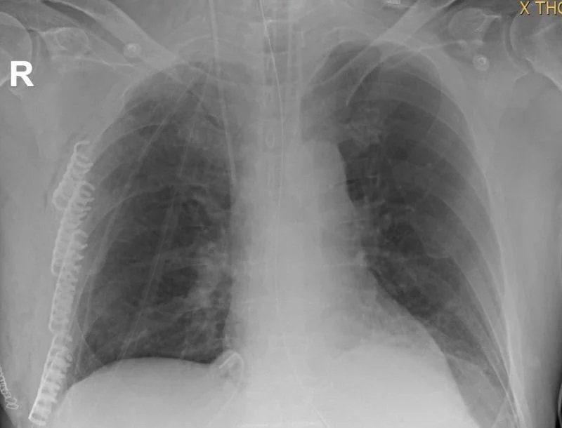 Röntgenbild des Brustkorbs zur Diagnose thoraxchirurgischer Erkrankungen.