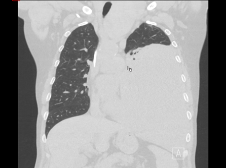 CT-Scan eines Brustkorbs zur Analyse von Lungenzuständen in der Thoraxchirurgie.
